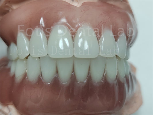 Prothèse complète en acrylique avec dents ivoclares