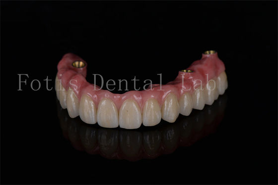 Restauration complète de l'arc tout sur quatre implants pour des performances optimales des implants dentaires