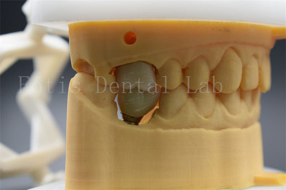 Implantation dentaire personnalisable couronne abutment confortable pour les patients
