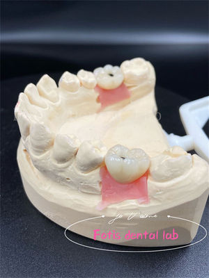 Titane/Ziconia/PFM couronnes de laboratoire dentaire confortables