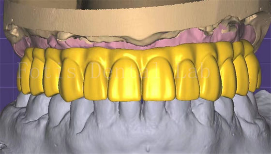 Conception de couronne en 3 formes professionnelle Excellente performance et durabilité