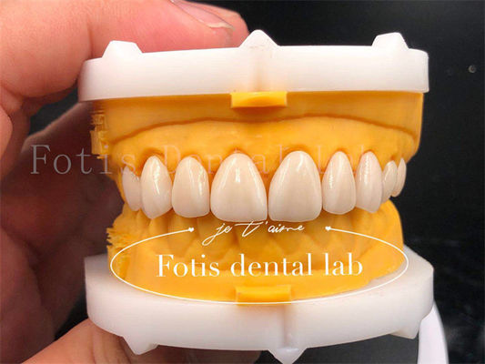 Des couronnes dentaires numériques rapides et efficaces Taille personnalisée couronne d'implant dentaire