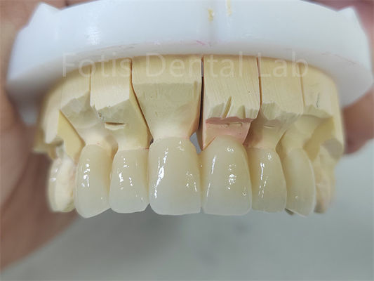 Produits dentaires en zirconium recouvert de porcelaine Facile à entretenir
