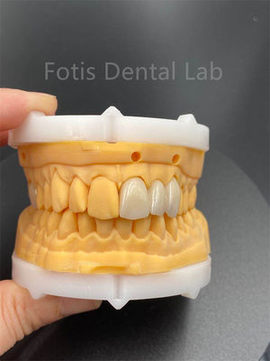 Céramique dentaire en zirconium multicouche de haute durabilité pour produit médical de laboratoire dentaire