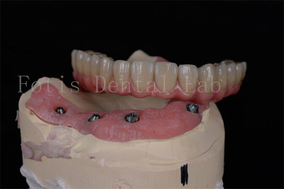 acheter Implants dentaires personnalisables pour une rééducation orale complète online manufacture