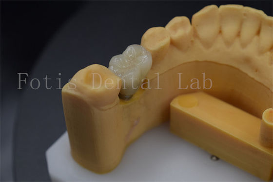 acheter Des couronnes confortables et durables destinées à la restauration des dents manquantes online manufacture
