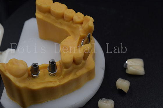 acheter Couronne d'implant dentaire de haute durabilité facile à régler online manufacture