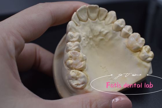 Effective E.Max / Composite Inlays And Onlays pour réparer les dents endommagées ou décadentes