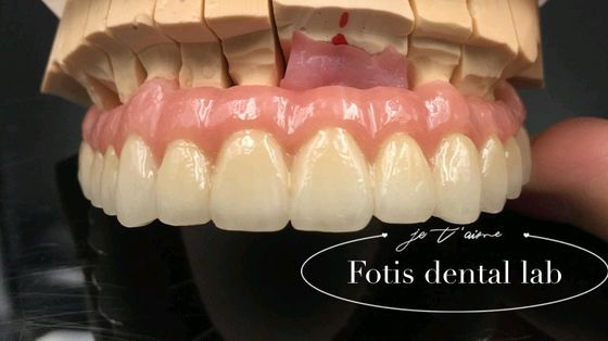 Restauration fiable PFM couronnes dentaires en porcelaine fusionnée à la couronne métallique personnalisée