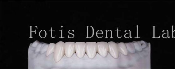 Durabilité élevée Veneurs dentaires à l'aspect naturel 0,3 mm-0,5 mm d'épaisseur