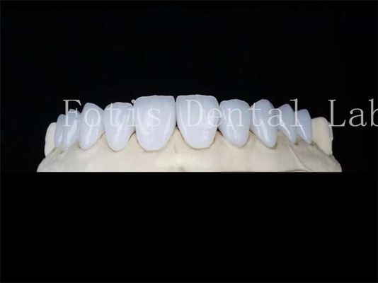 Fabrication sur mesure en porcelaine naturelle Fabrication de laboratoire dentaire