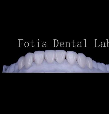 Durabilité de la texture lisse Les dents couvrent les facettes Les facettes dentaires naturelles