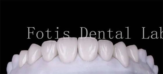 Polissage finition cosmétique couvre de placage de dents pour un beau sourire