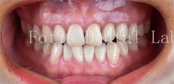 Dentisterie et cosmétique Porcelaine dentaire à haute résistance aux taches