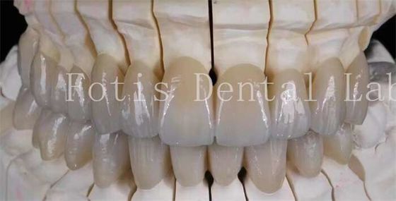 Sourire d'aspect naturel Prothèse en porcelaine lamellée Faisceaux de surface lisse