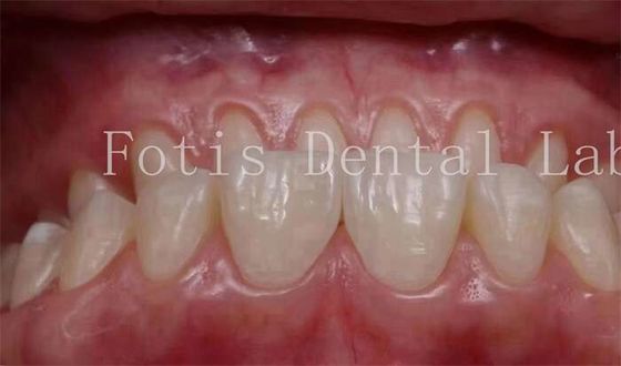 0.3-0.5mm épaisseur couvre les dents cosmétiques placages pour la dentisterie cosmétique