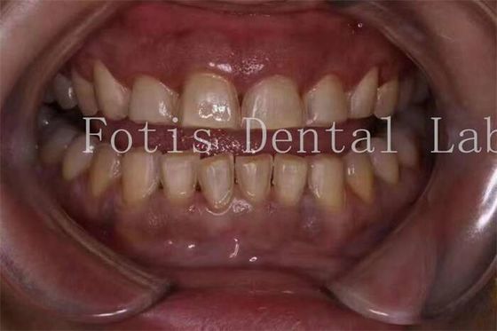 Fabrication personnalisée de placages pour dents en porcelaine avec une surface lisse
