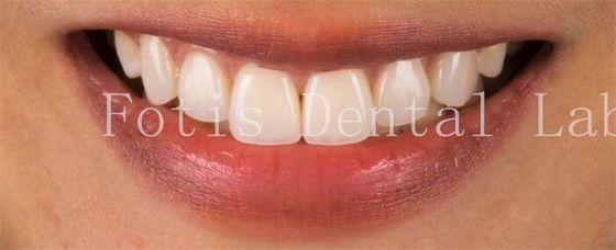 Les facettes de dents cosmétiques haut de gamme pour une résistance parfaite aux taches de sourire