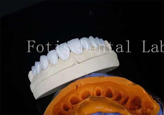 Porcelaine de laboratoire dentaire placage de ciment de liaison pour les restaurations durables