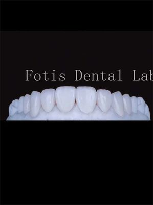 Les facettes dentaires en porcelaine à haute transparence améliorent naturellement votre sourire