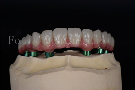 Titane/Zirconium durable Tout sur 4/6 Implants Facile d'entretien Taux de réussite élevé