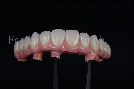 Restauration de la capacité à mâcher avec 4 ou 6 implants