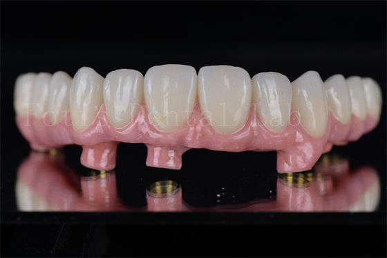 Les implants dentaires individuels tous sur 4 tous sur 6 rétablissent la pleine capacité à mâcher
