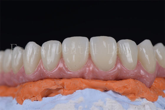 Des implants dentaires innovants et peu invasifs tous sur 4 tous sur 6 en 1-2 semaines
