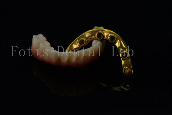 Titane Zirconia Tout sur 4 Tout sur 6 Implants Plein sourire Implants Garantie à vie