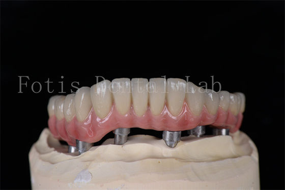 Minimalement invasif Le même jour, tous sur 4 tous sur 6 Implants naturels, faciles à nettoyer
