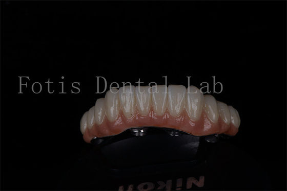 Restauration de la bouche entière tout sur 4 et tout sur 6 Titane ou Zirconia Taux de réussite élevé