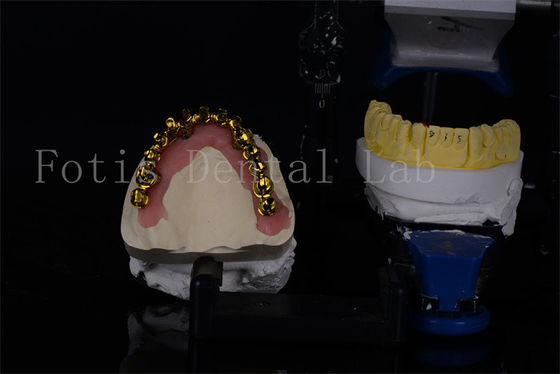 Des implants dentaires en titane / zirconium tout sur 4 à prix abordable pour un sourire naturel