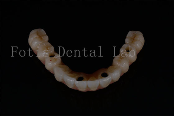 Remplacement des implants dentaires avancés pour une fonction optimale