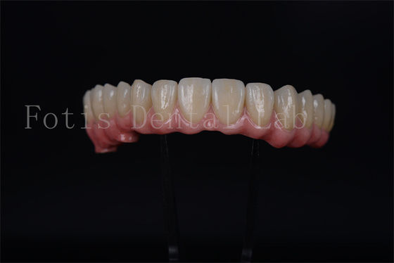 Le pont d'implant à pleine voûte tout sur 4 tout sur 6 pour une restauration dentaire complète