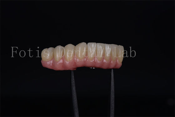 Rapide et efficace tous sur quatre tous sur six en une journée Implants Sécurité assurée