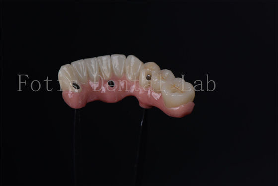 Implants endostatiques individuels pour le remplacement immédiat des dents