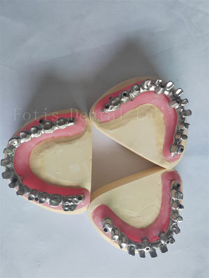 La solution parfaite pour la restauration des implants dentaires
