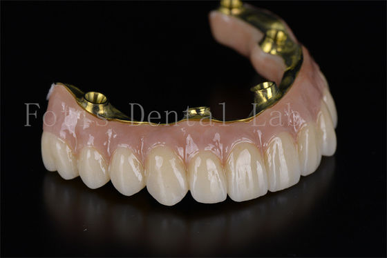 Reconstruction complète de la bouche tout sur 4 tout sur 6 système d'implant dentaire