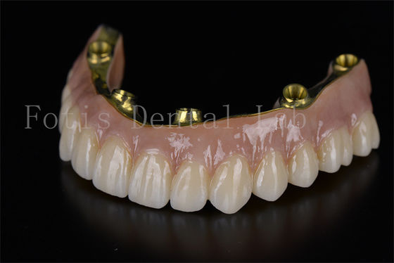 Restauration complète de l' arc tout sur six implants solution minimalement invasive