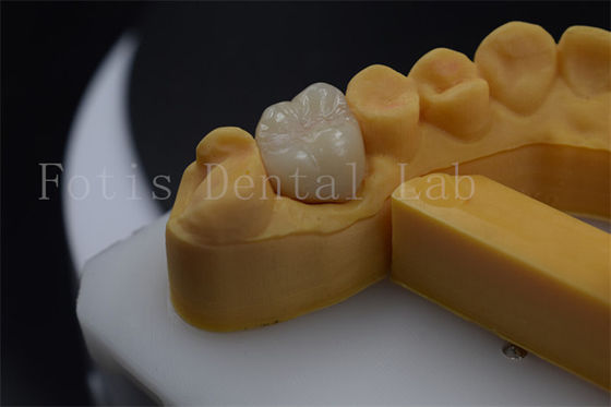 Titane / PFM Prothèse de couronne personnalisable couronne d'implant de zirconium durable