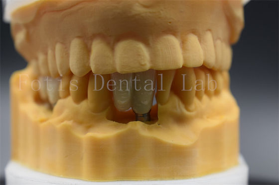 Implantation dentaire sur mesure, couronne de précision adaptée aux dents manquantes