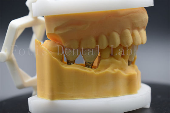 Couronne dentaire en titane de précision pour implant dentaire facile à nettoyer et à entretenir