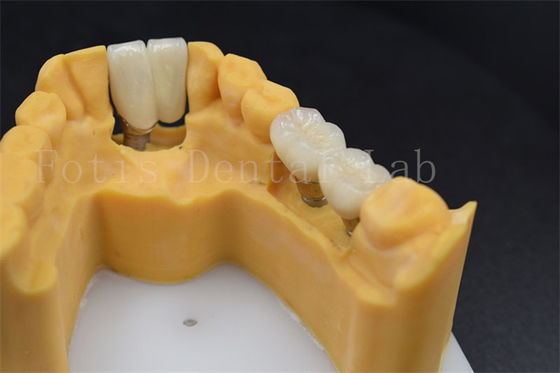 Restauration dentaire personnalisable Remplacement de couronne d'implant