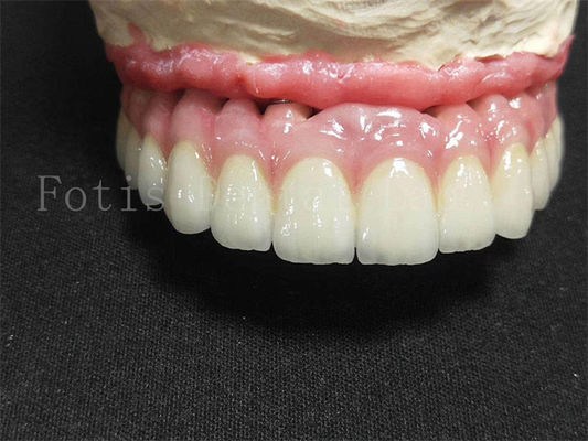 Couronne d'implant en titane / zirconium finition polie couronne dentaire artificielle