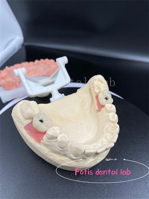 Cornes dentaires à bouche pleine, de précision, faciles à placer