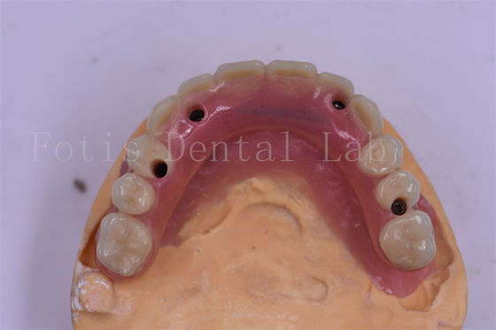 Implant dentaire en titane couronne dentaire de précision adaptation personnalisée