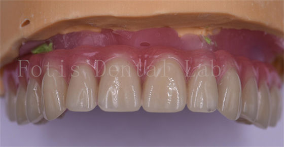 Confort du patient Couronnes dentaires personnalisées en titane poli/zirconia/couronne d'implant PFM