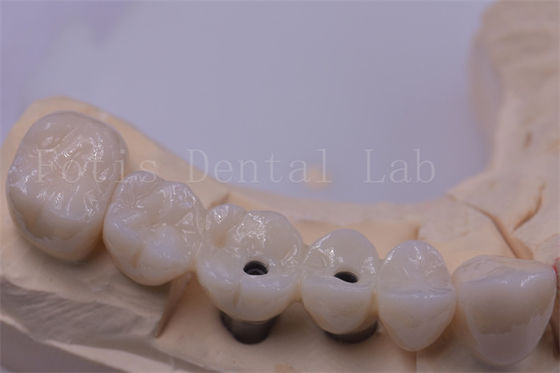 Couronne dentaire en titane / zirconium argentée pour les dents manquantes