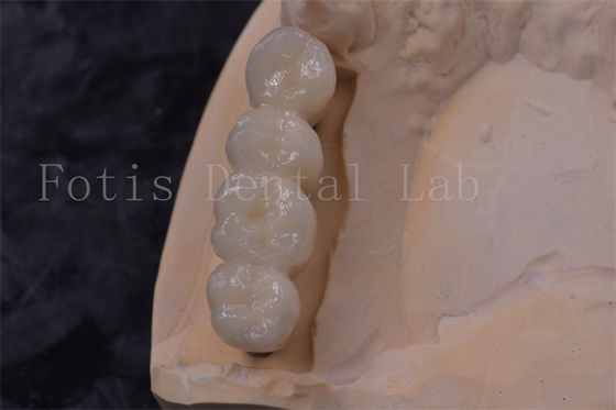 Implantation de couronne dentaire en zirconium de précision facile à nettoyer
