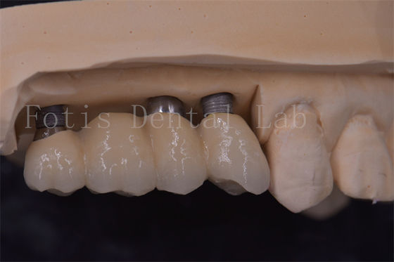 Implantation dentaire de précision couronnes de titane / zirconium / PFM restauration des dents manquantes